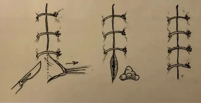 手绘插图，分三组展示手术缝合与拆线的步骤：持刀切开、打结固定缝线、拆除缝线结。